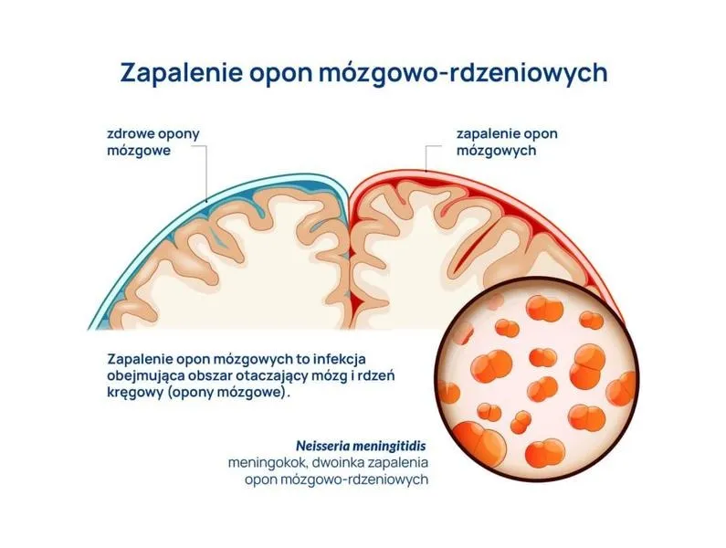Jak skutecznie sprawdzić objawy zapalenia opon mózgowych?