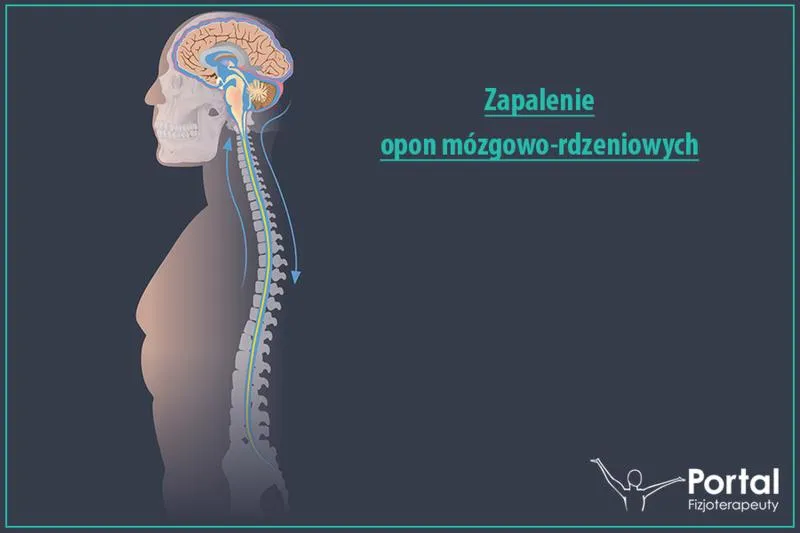 Czynniki wpływające na zapalenie opon mózgowych